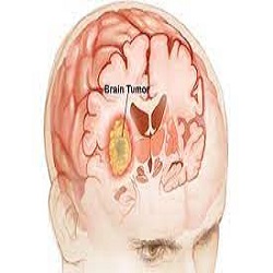 Brain Tumor