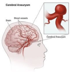 Cerebral Aneurysm