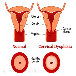 Cervical Dysplasia